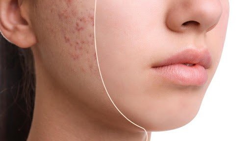 How to Get Rid of Acne Scars Naturally