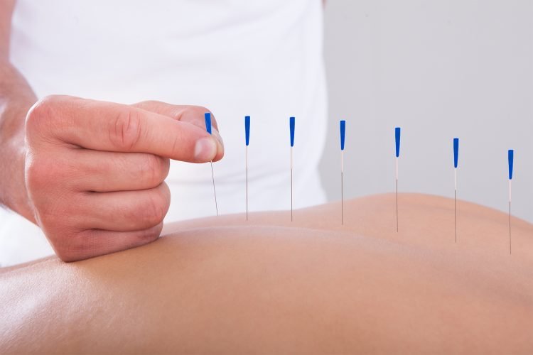 Acupuncture points being applied for Qi balance