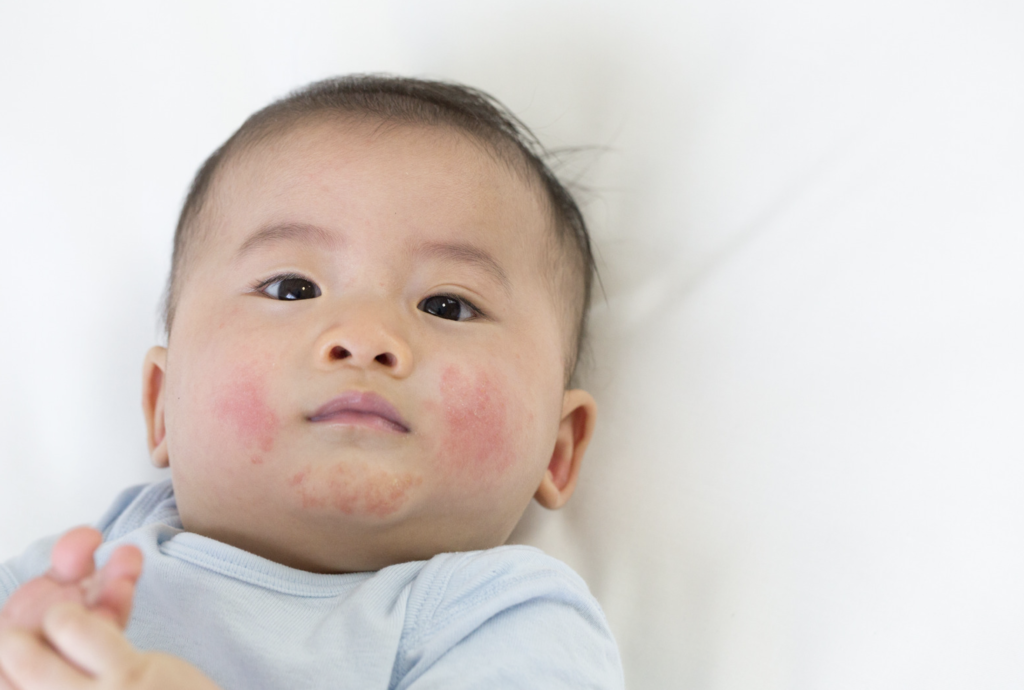 Natural Remedies for Eczema in Infants and Toddlers