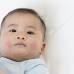 Natural Remedies for Eczema in Infants and Toddlers