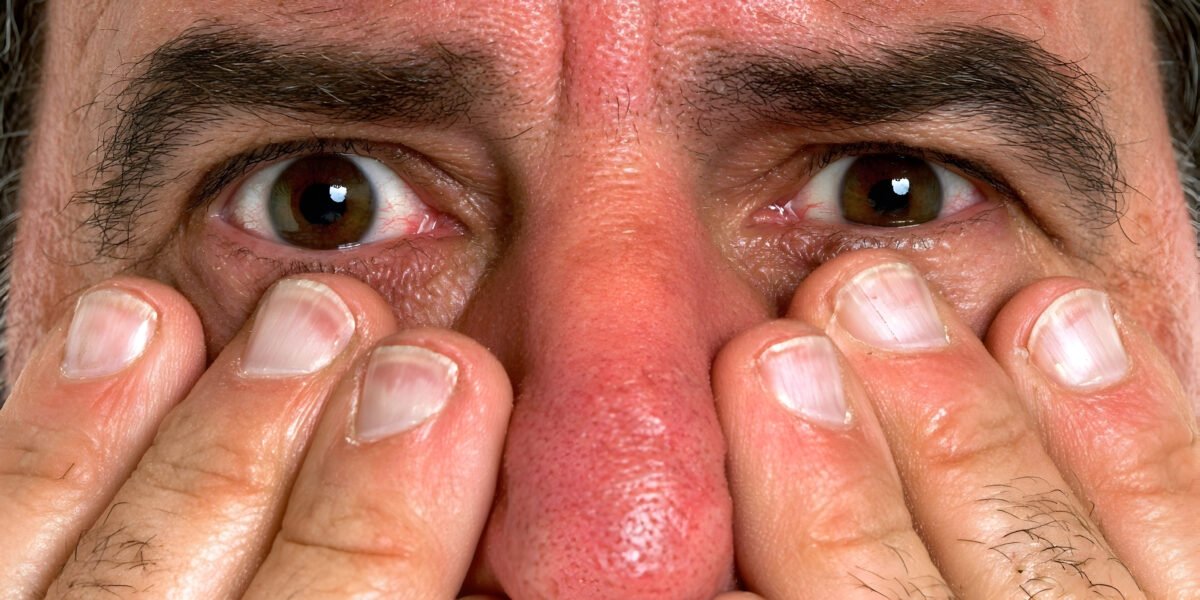 dry eyes herbal remedy